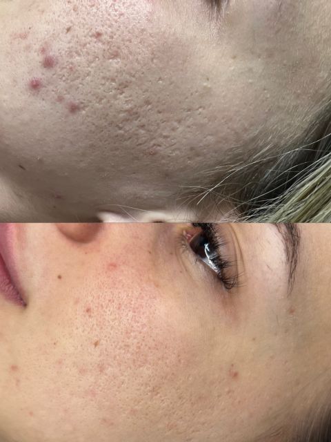 Microneedling cicatrici post acneice made by Noemi Vincze - from Stailer