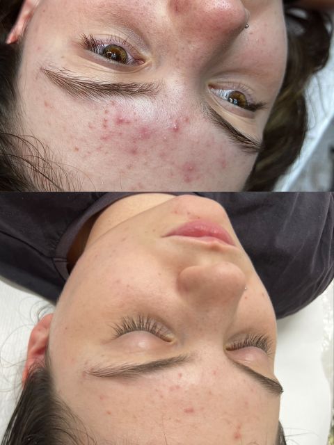 Tratament facial - Acnee