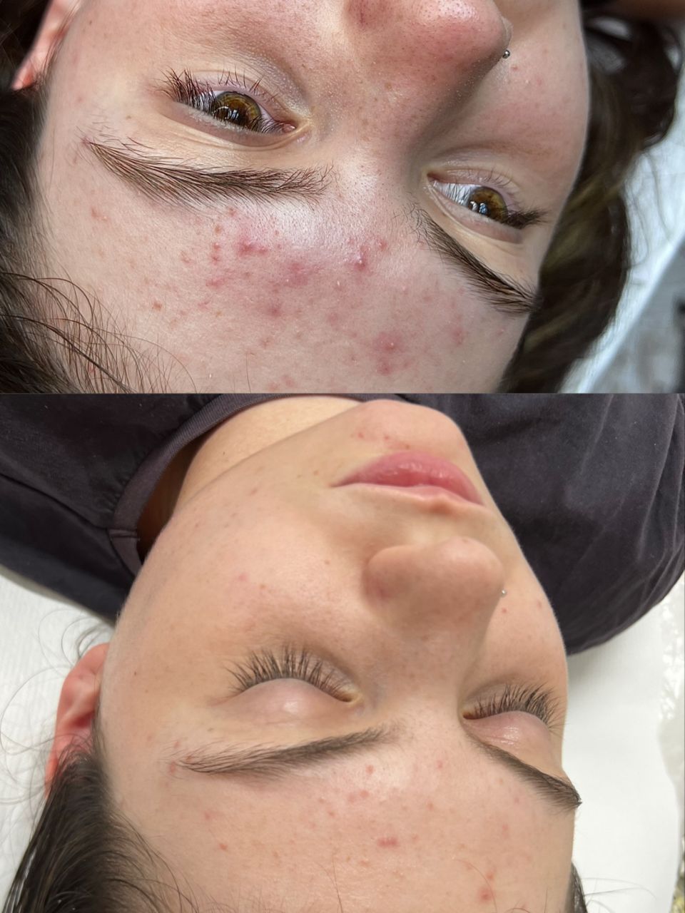 Tratament facial - Acnee made by Noemi Vincze - from Stailer Tratament facial - Acnee made by Noemi Vincze - from Stailer