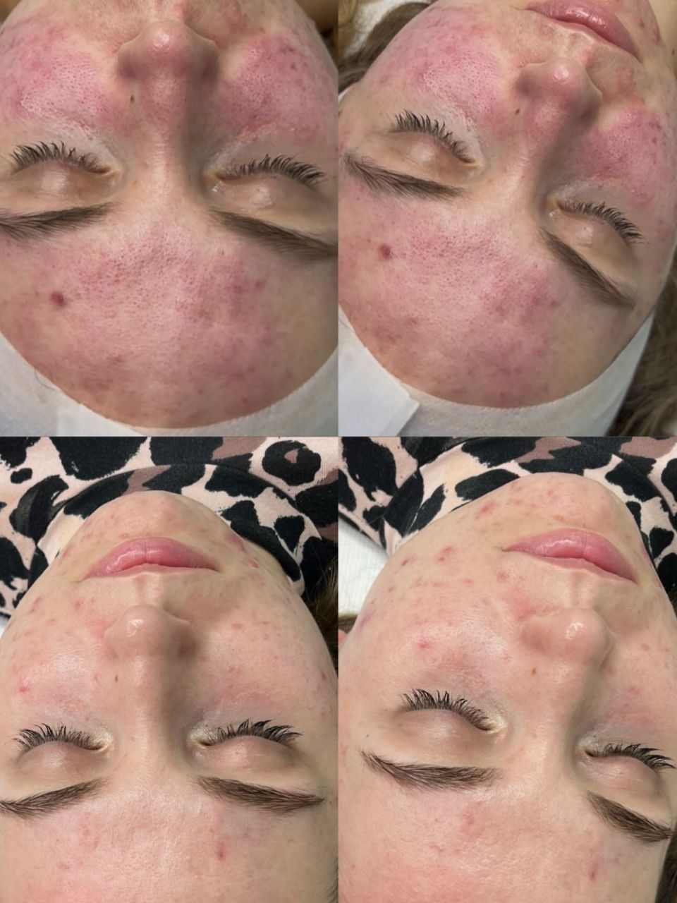 Tratament rosacee made by Noemi Vincze - from Stailer