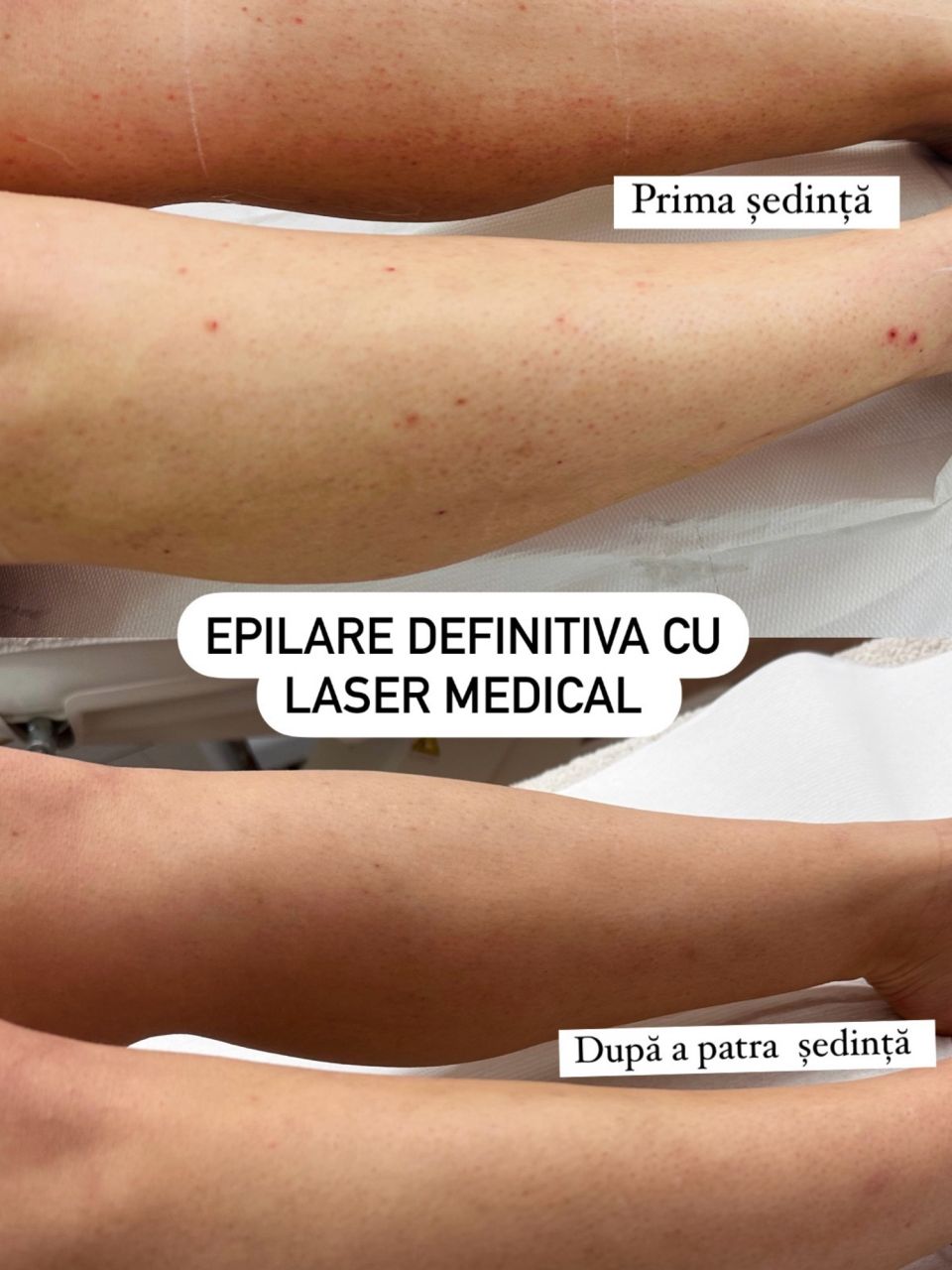 Epilare definitiva - picioare lung made by Angela Petruta - from Stailer Epilare definitiva - picioare lung made by Angela Petruta - from Stailer
