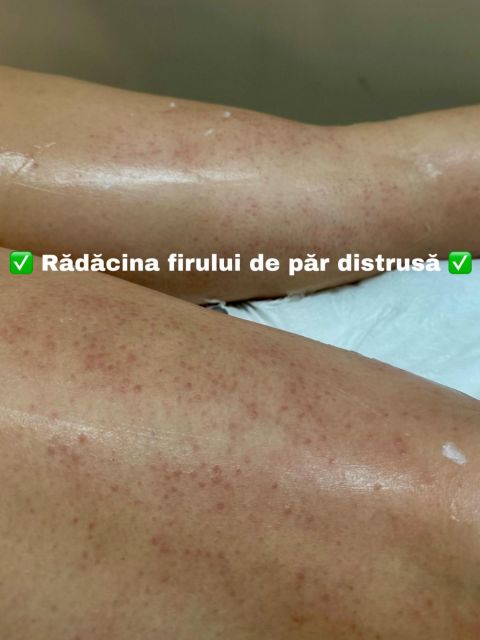 Epilare definitiva- picioare lung made by Gabriela Veronica Neamtu - from Stailer