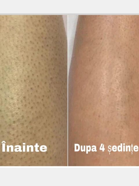 Epilare definitiva- picioare lung made by Gabriela Veronica Neamtu - from Stailer