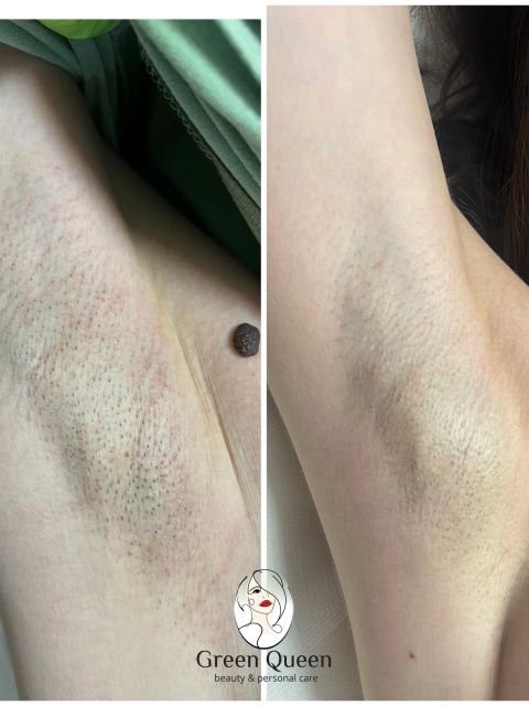 Oferta epilare definitiva 1 + 1 - inghinal si axila made by Ioana Telean - from Stailer