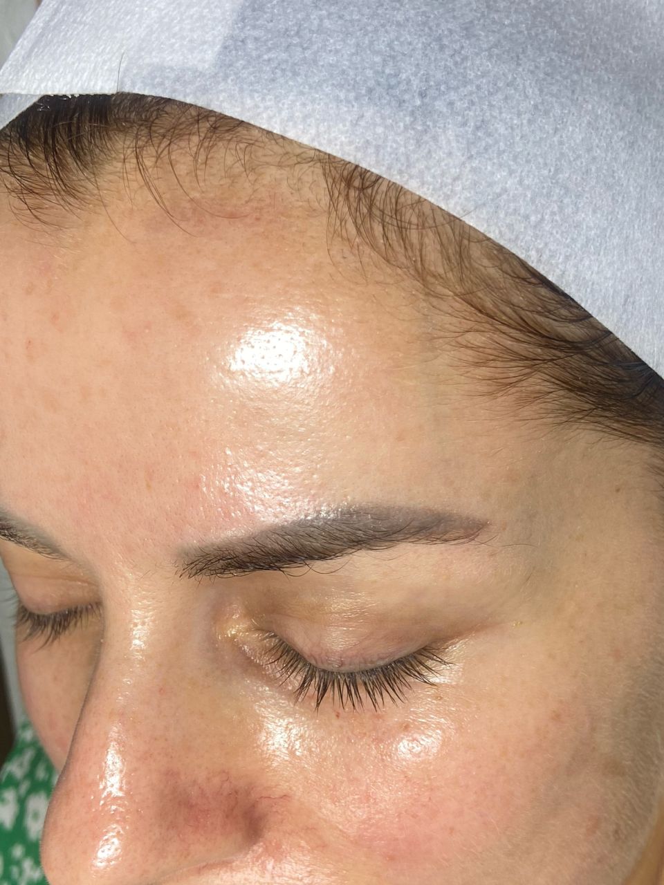 Microneedling made by Lidia Zaporojan - from Stailer