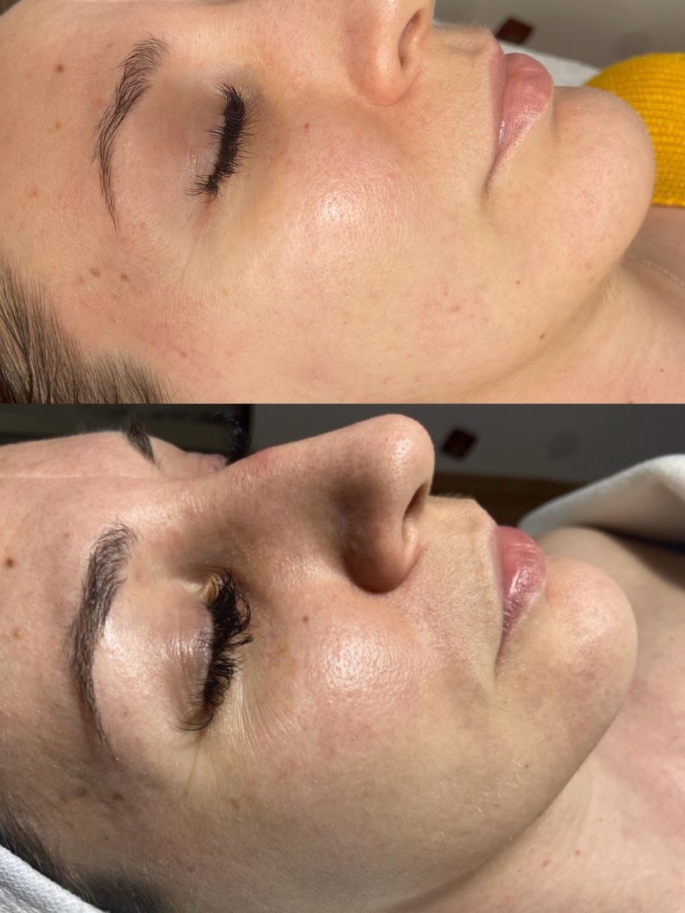 Microneedling si Biorepeel made by Lidia Zaporojan - from Stailer Microneedling si Biorepeel made by Lidia Zaporojan - from Stailer