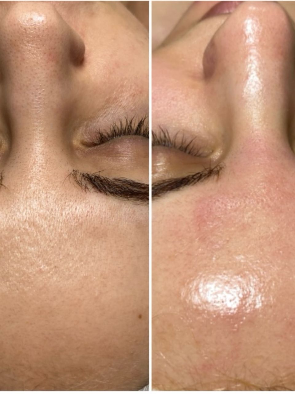 Microneedling si Biorepeel made by Lidia Zaporojan - from Stailer