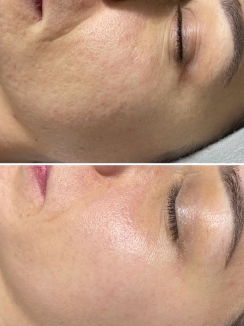 Microneedling si Biorepeel made by Lidia Zaporojan - from Stailer