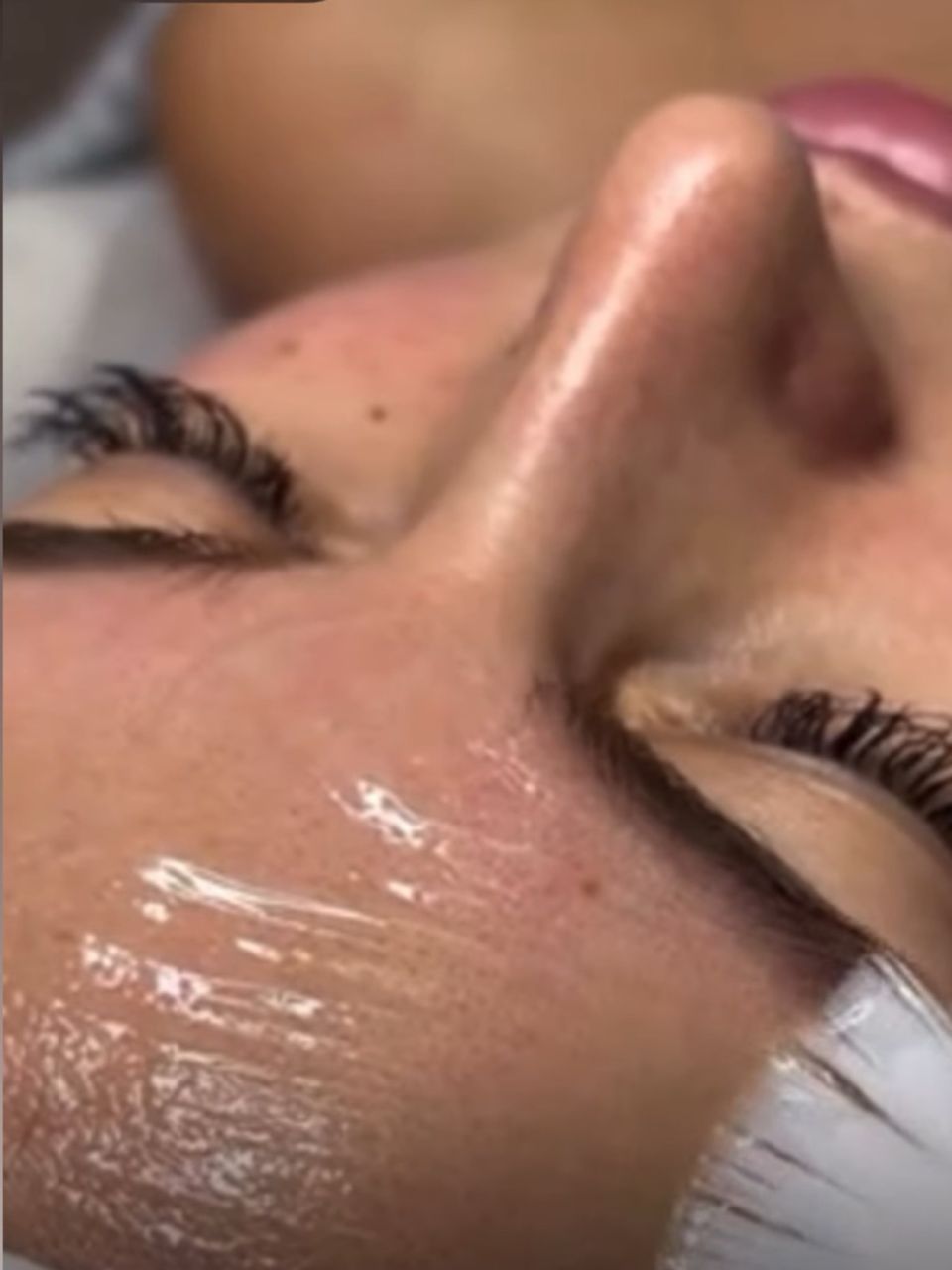 Microneedling si Carboxiterapie made by Lidia Zaporojan - from Stailer Microneedling si Carboxiterapie made by Lidia Zaporojan - from Stailer