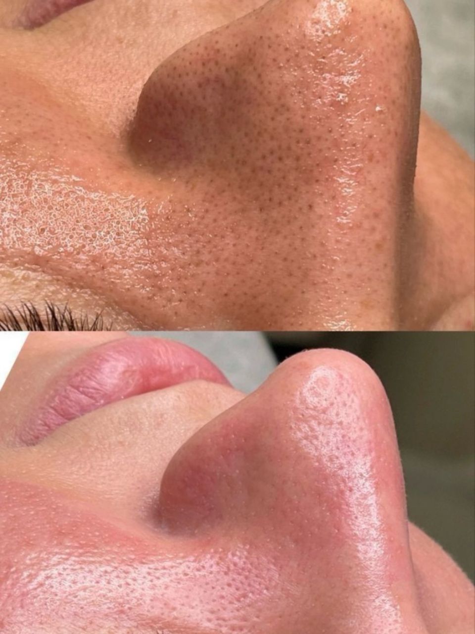 Tratament facial - 3D Curatare intensa  a tenului acneic made by Lidia Zaporojan - from Stailer