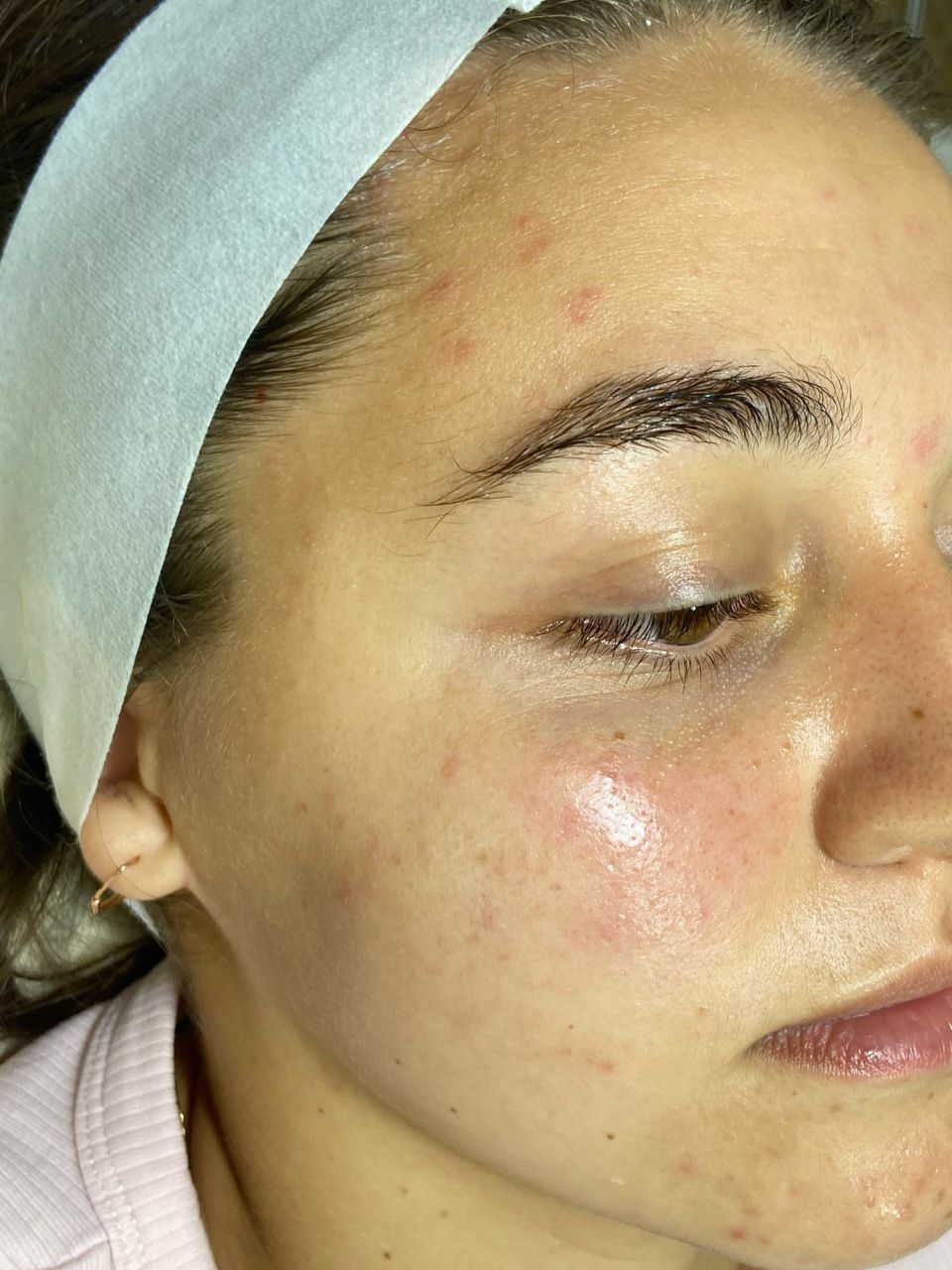 Tratament facial - 3D Curatare intensa  a tenului acneic made by Lidia Zaporojan - from Stailer