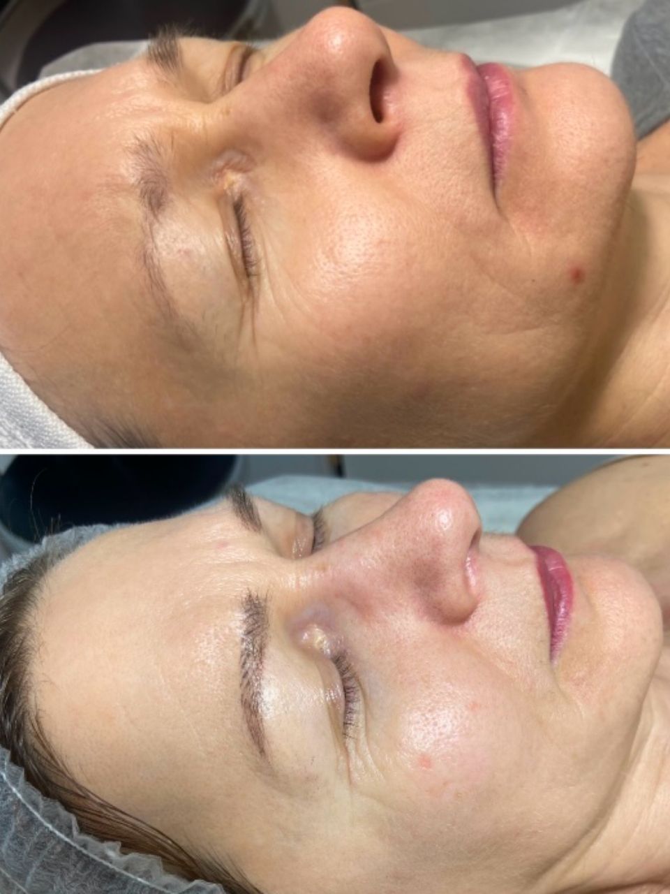 Tratament facial - Biorepeel made by Lidia Zaporojan - from Stailer
