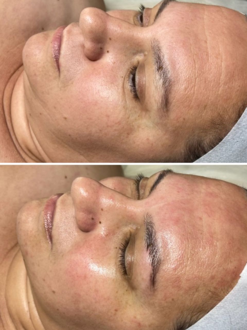 Tratament facial - Carboxi Terapie 3D Lifting made by Lidia Zaporojan - from Stailer Tratament facial - Carboxi Terapie 3D Lifting made by Lidia Zaporojan - from Stailer