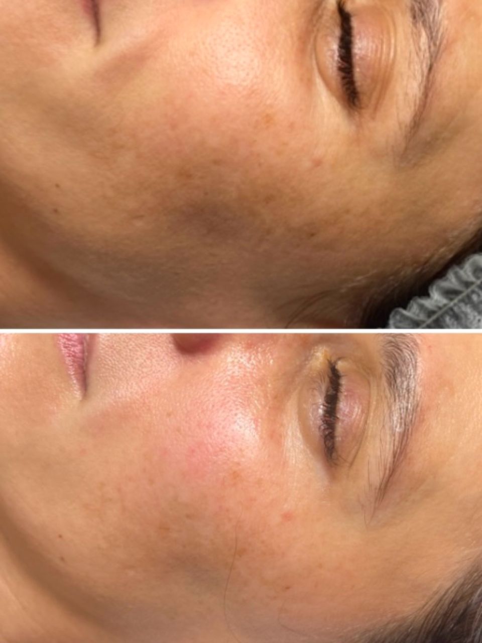 Tratament facial - Carboxi Terapie 3D Lifting made by Lidia Zaporojan - from Stailer