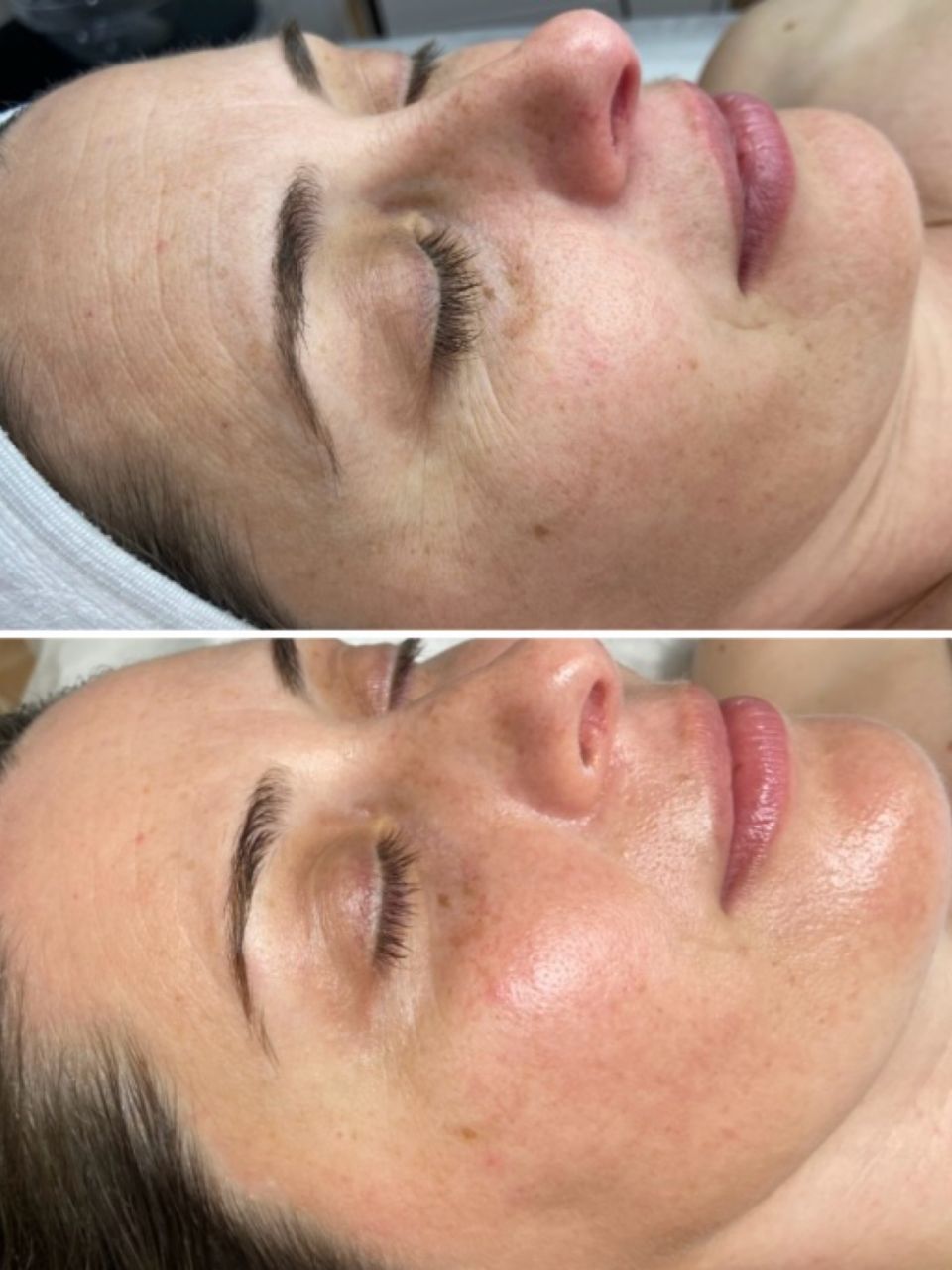 Tratament facial - Carboxi Terapie 3D Lifting made by Lidia Zaporojan - from Stailer