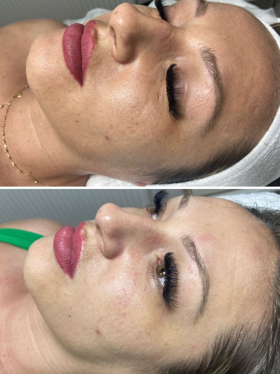 Tratament facial - Carboxi Terapie 3D Lifting made by Lidia Zaporojan - from Stailer