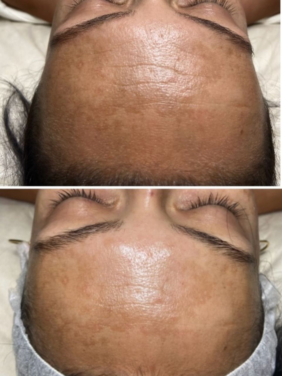 Tratament facial - Carboxi Terapie 3D Lifting made by Lidia Zaporojan - from Stailer