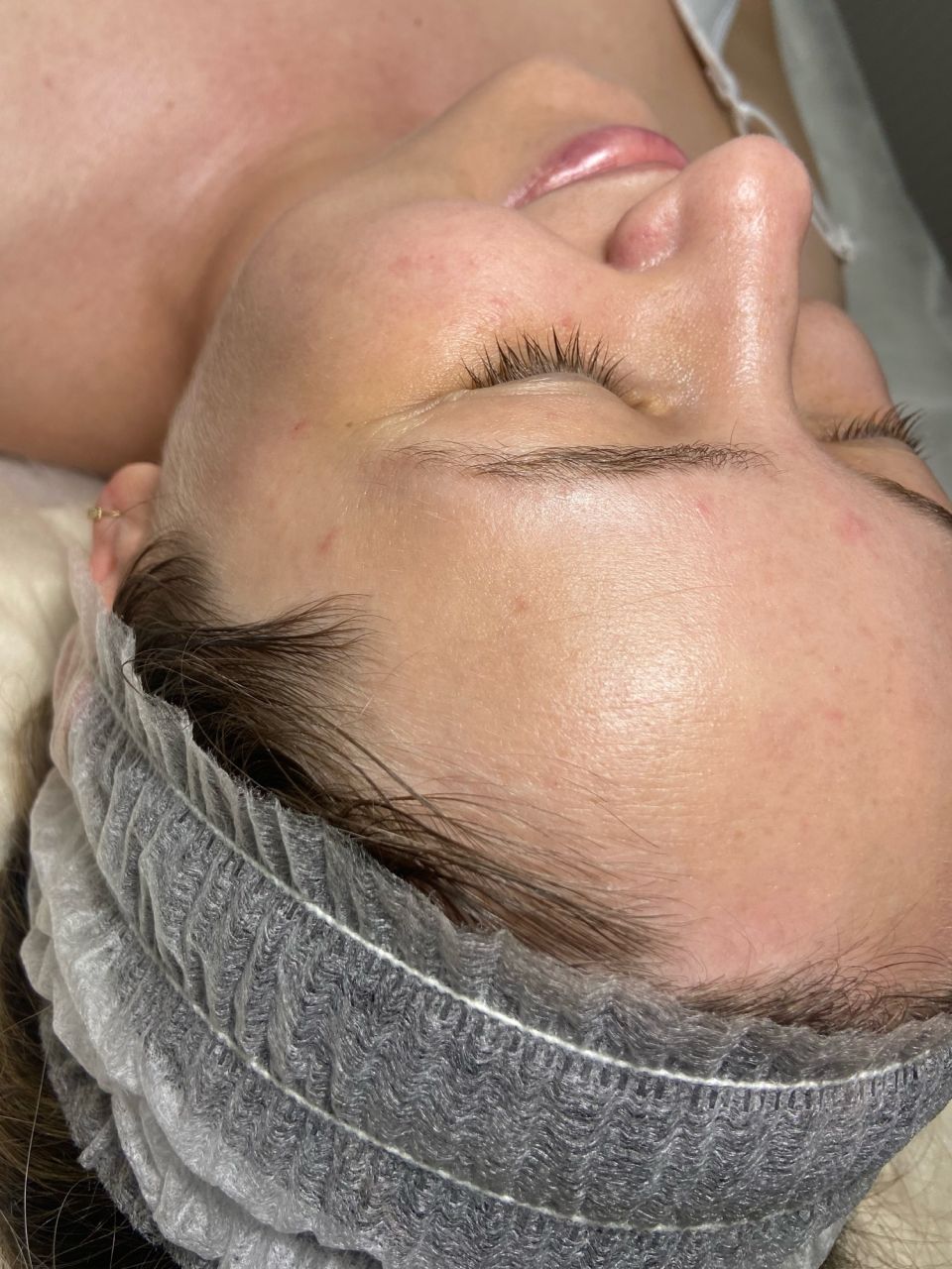Tratament facial - Carboxi Terapie 3D Lifting made by Lidia Zaporojan - from Stailer