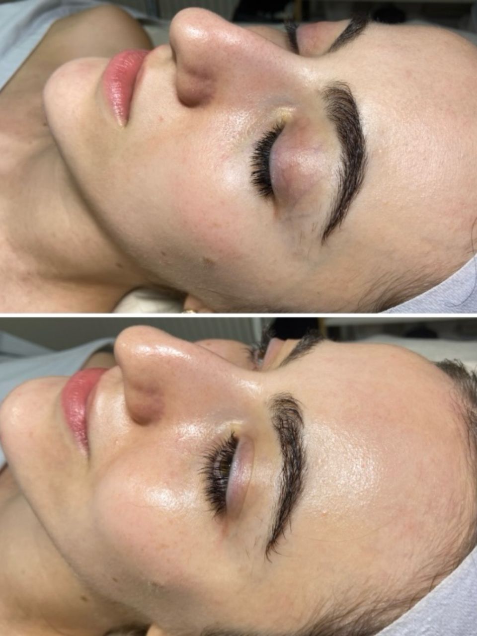 Tratament facial - Peeling chimic made by Lidia Zaporojan - from Stailer