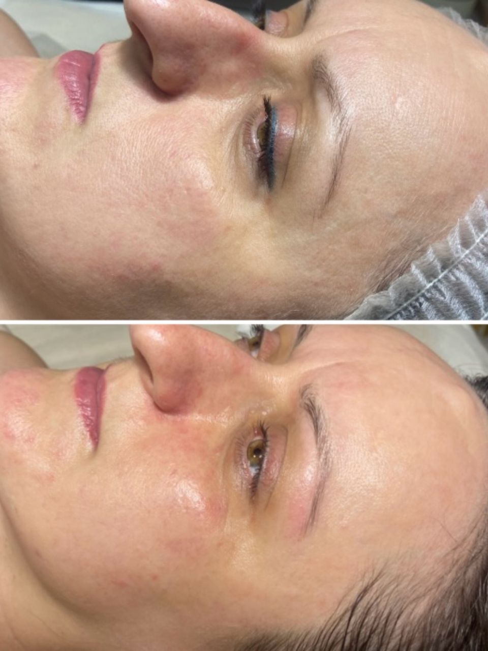 Tratament facial - Peeling chimic made by Lidia Zaporojan - from Stailer Tratament facial - Peeling chimic made by Lidia Zaporojan - from Stailer