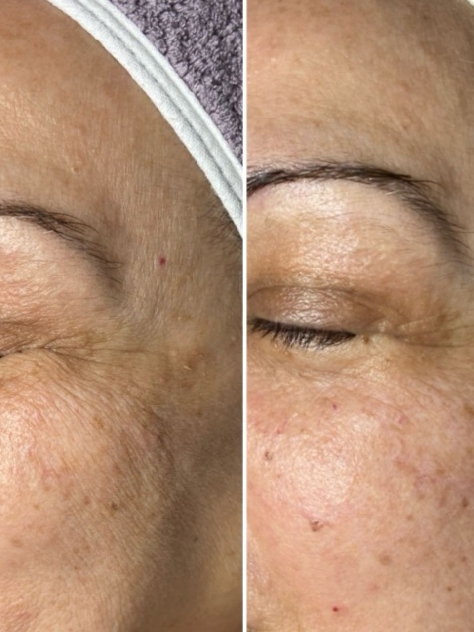 Tratament facial - Peeling chimic made by Lidia Zaporojan - from Stailer