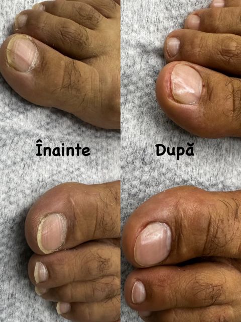 Pedichiura medicala si laminare unghii 
