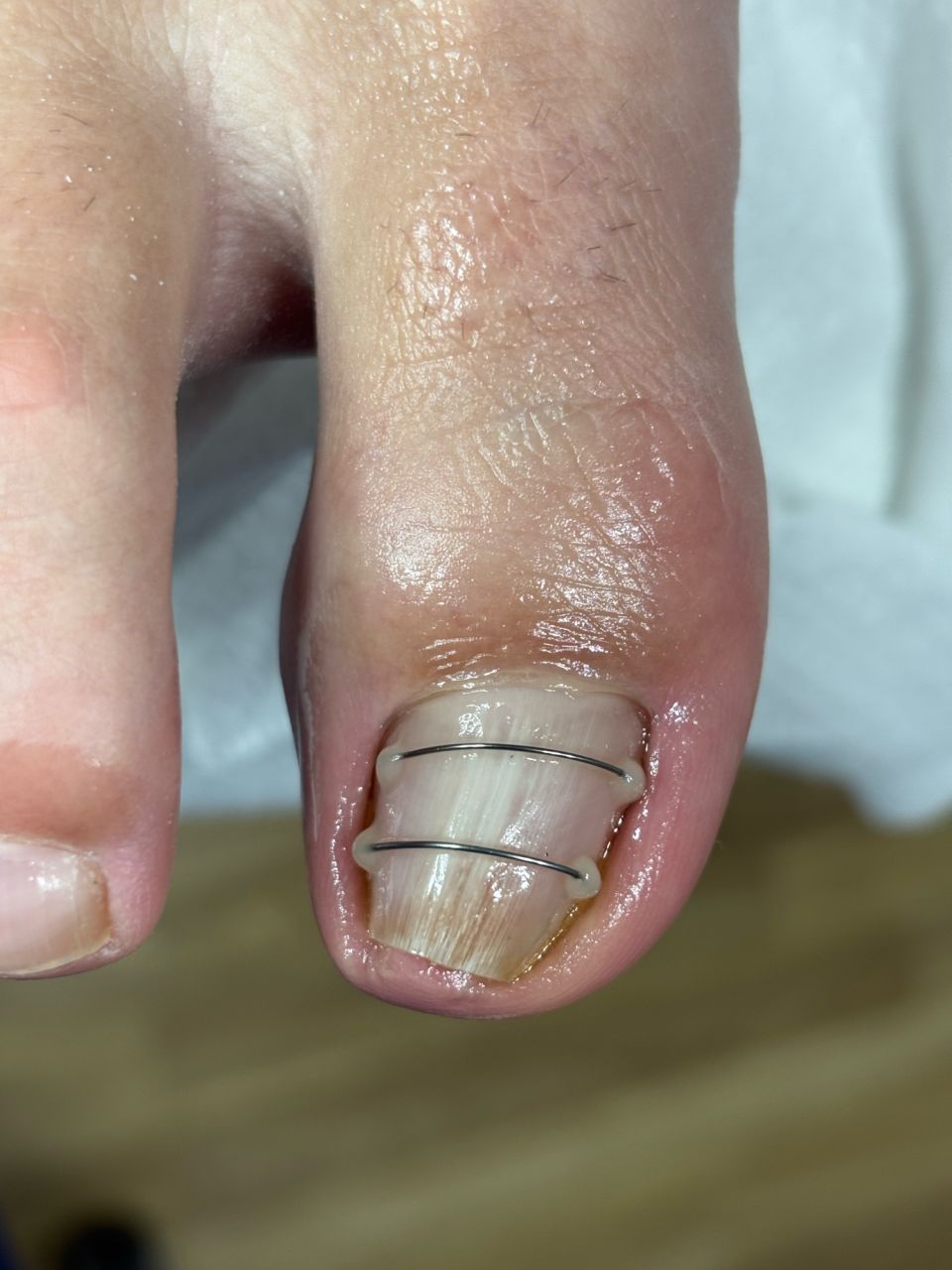 Corectie unghie mare incarnata made by Bianca Moldovan - from Stailer