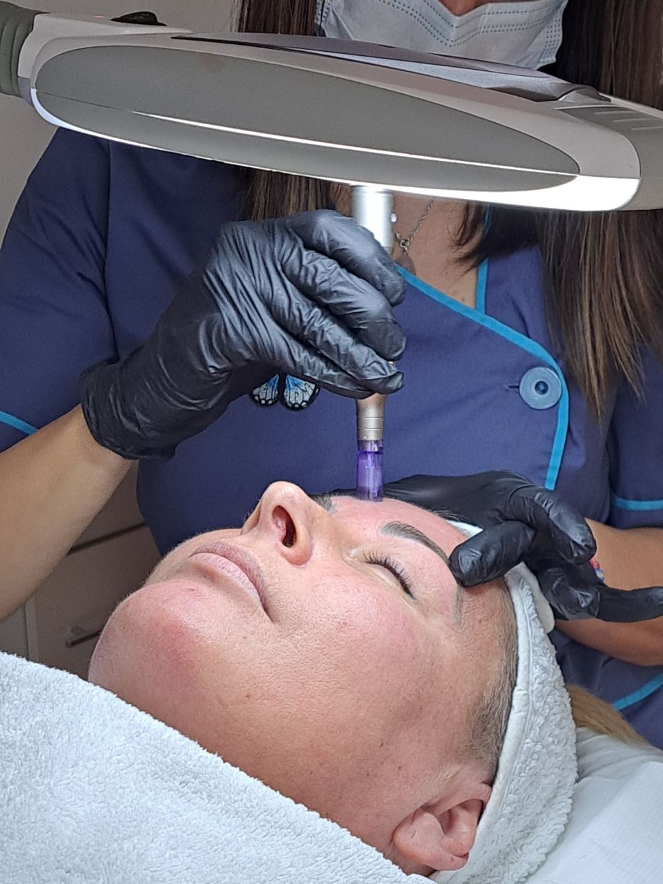 Microneedling made by Aida Ungureanu - from Stailer