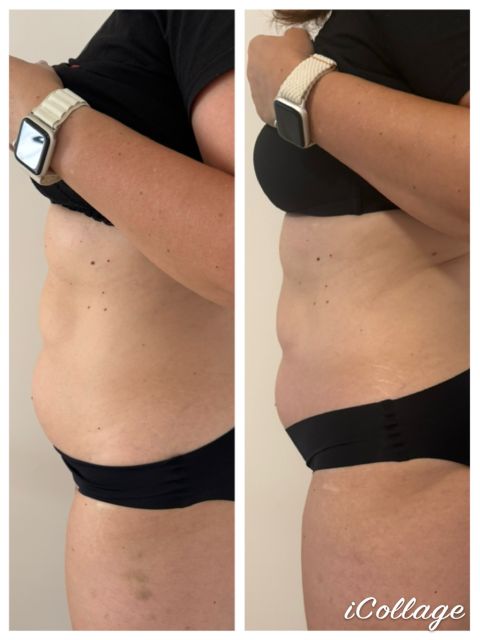 Criolipoliza - 1 aplicator