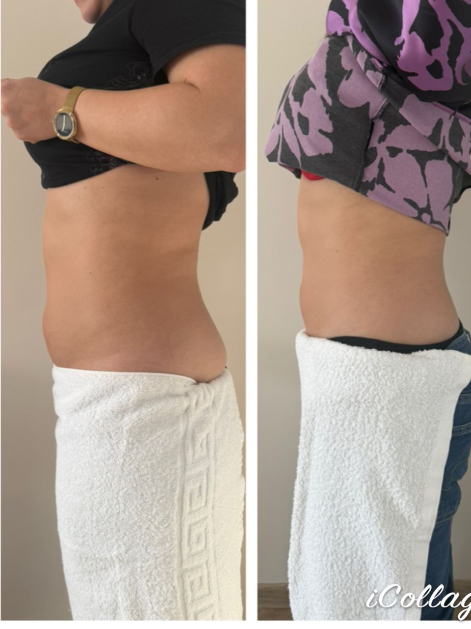 Criolipoliza - 1 aplicator made by Dalia Lonca - from Stailer