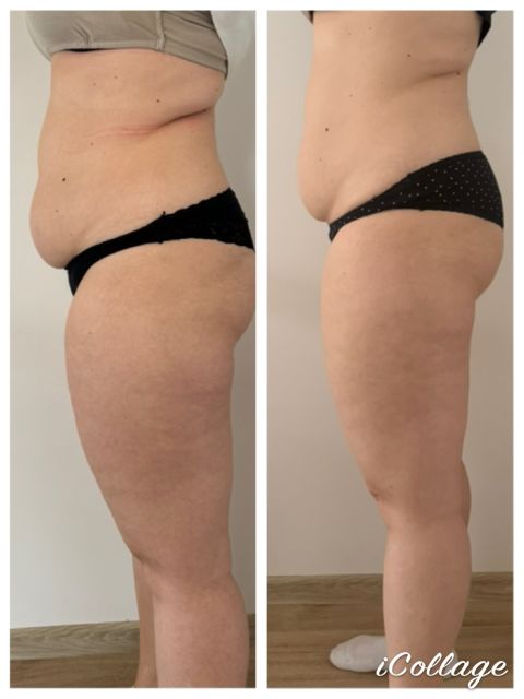 Viora V-FORM - Abdomen mare