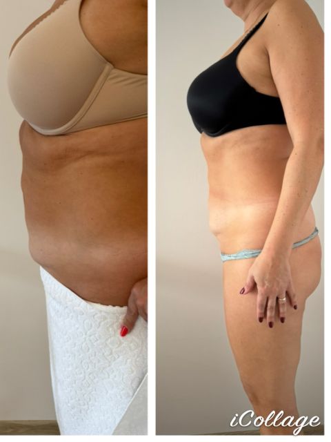 Viora V-FORM - Abdomen mare