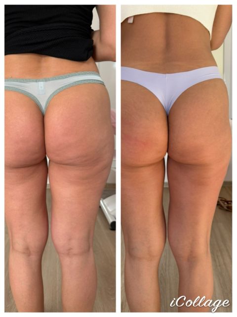 Viora V-FORM - Coapse exterior si Fese - 6 sedinte