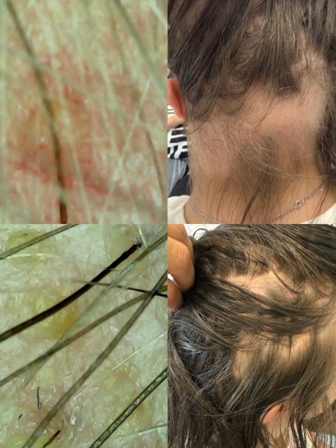 Consultatie scalp cu tricocamera made by Alexandra Marcut - from Stailer