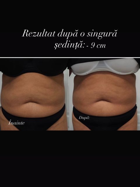 Lipoliza fara ac made by Alexandra Marcut - from Stailer