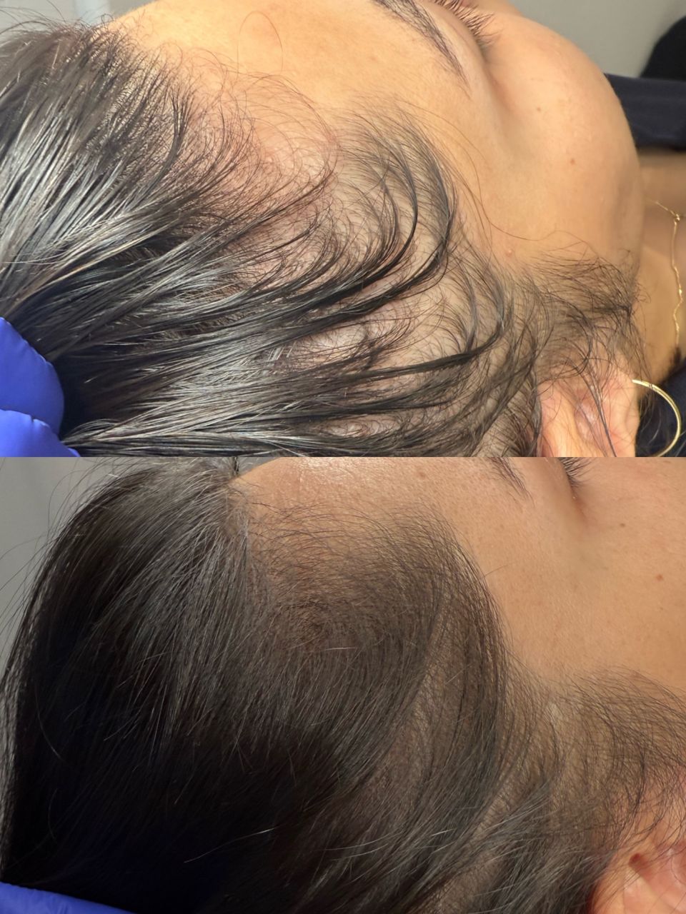 Mezoterapie Scalp made by Alexandra Marcut - from Stailer