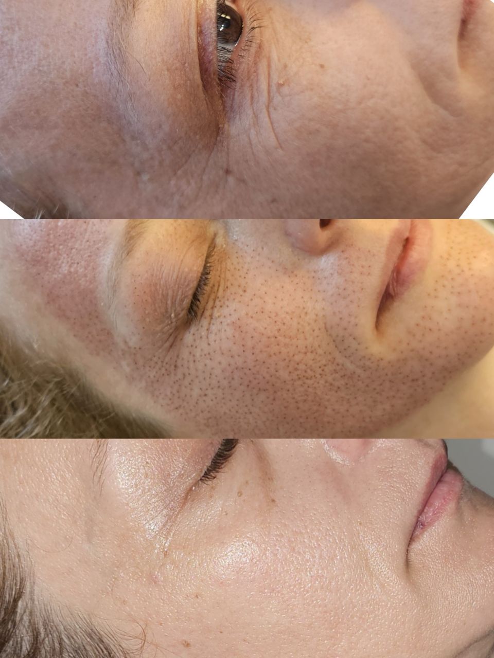 Tratament PlasmaPen made by Alexandra Marcut - from Stailer