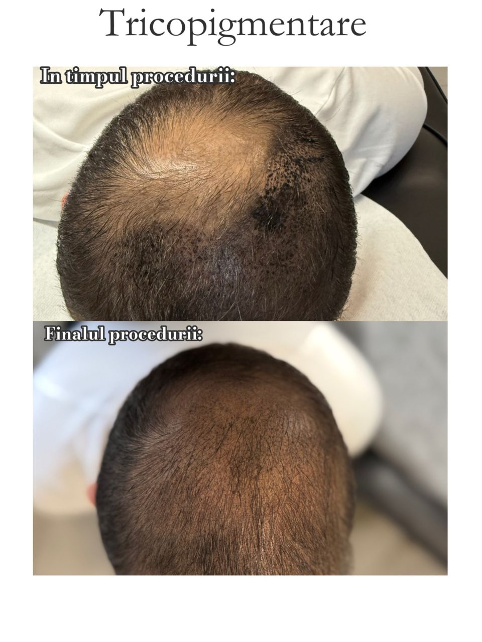 Tricopigmentare Scalp made by Alexandra Marcut - from Stailer