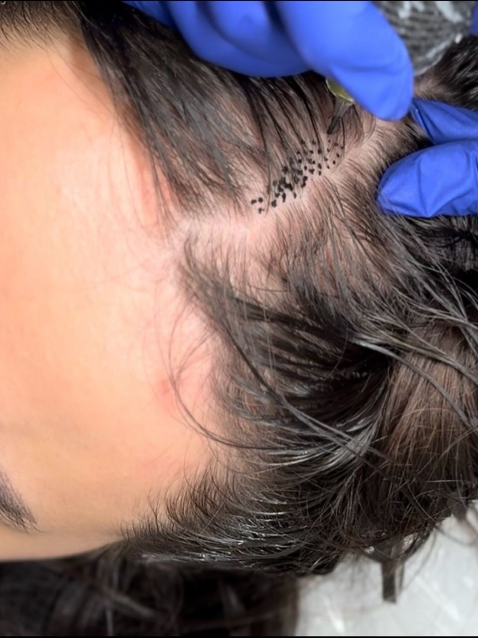 Tricopigmentare Scalp made by Alexandra Marcut - from Stailer