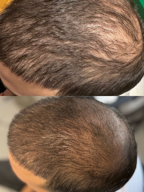 Tricopigmentare Scalp