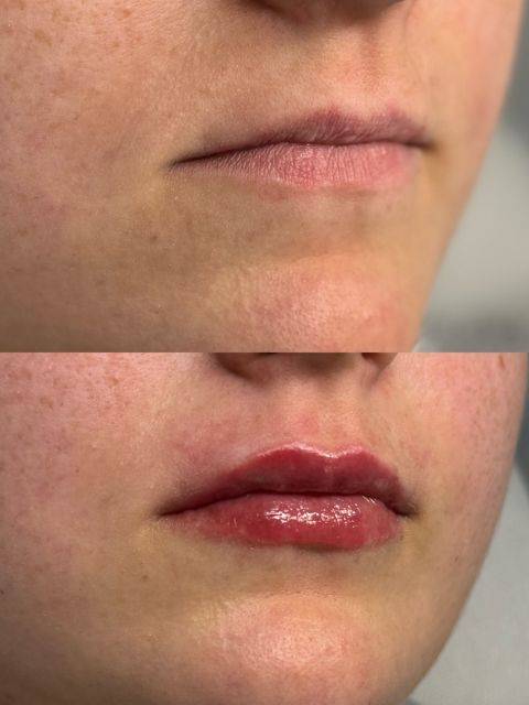 Volumizare buze cu Hyaluronpen  made by Alexandra Marcut - from Stailer