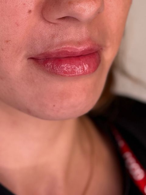 Volumizare buze cu Hyaluronpen  made by Alexandra Marcut - from Stailer