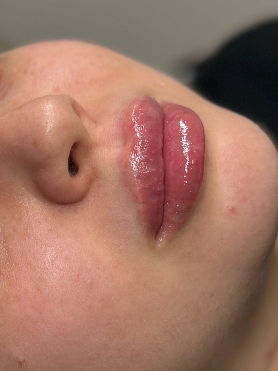 Volumizare buze cu Hyaluronpen  made by Alexandra Marcut - from Stailer