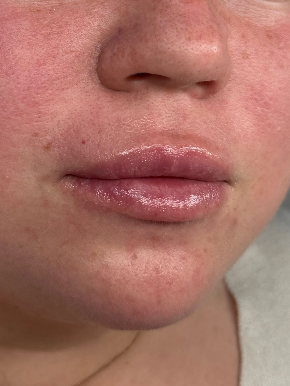 Volumizare buze cu Hyaluronpen  made by Alexandra Marcut - from Stailer