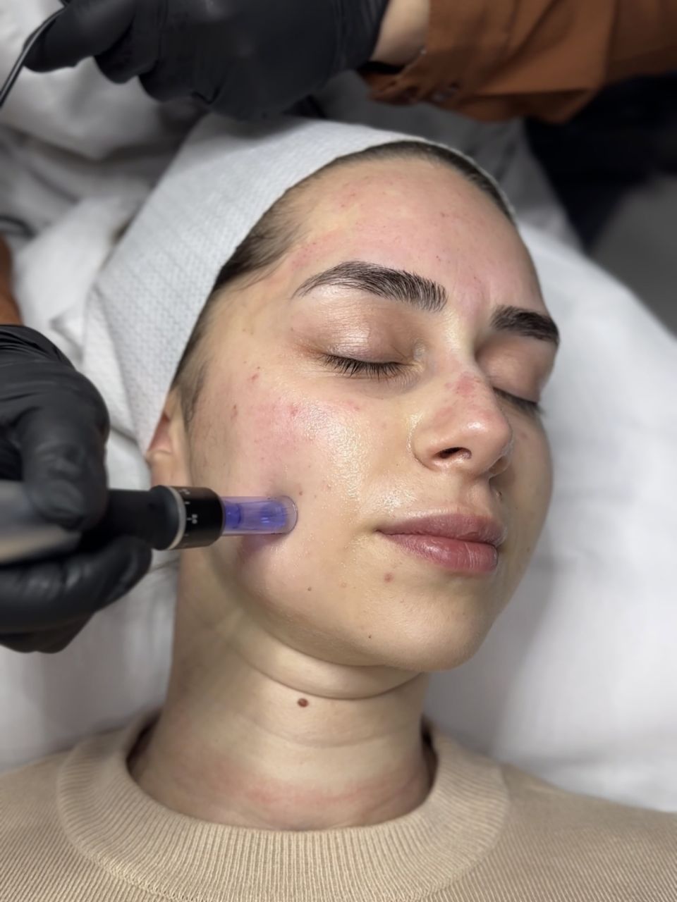 Microneedling made by Roxana Szakacs - from Stailer