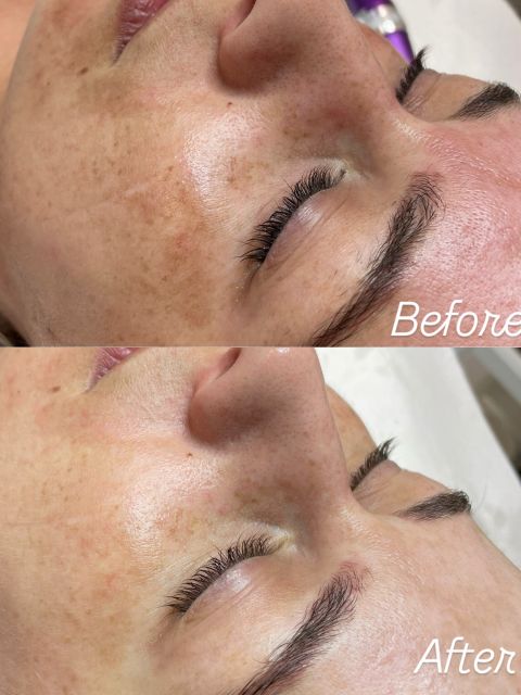 Microneedling made by Corina Dinu - from Stailer