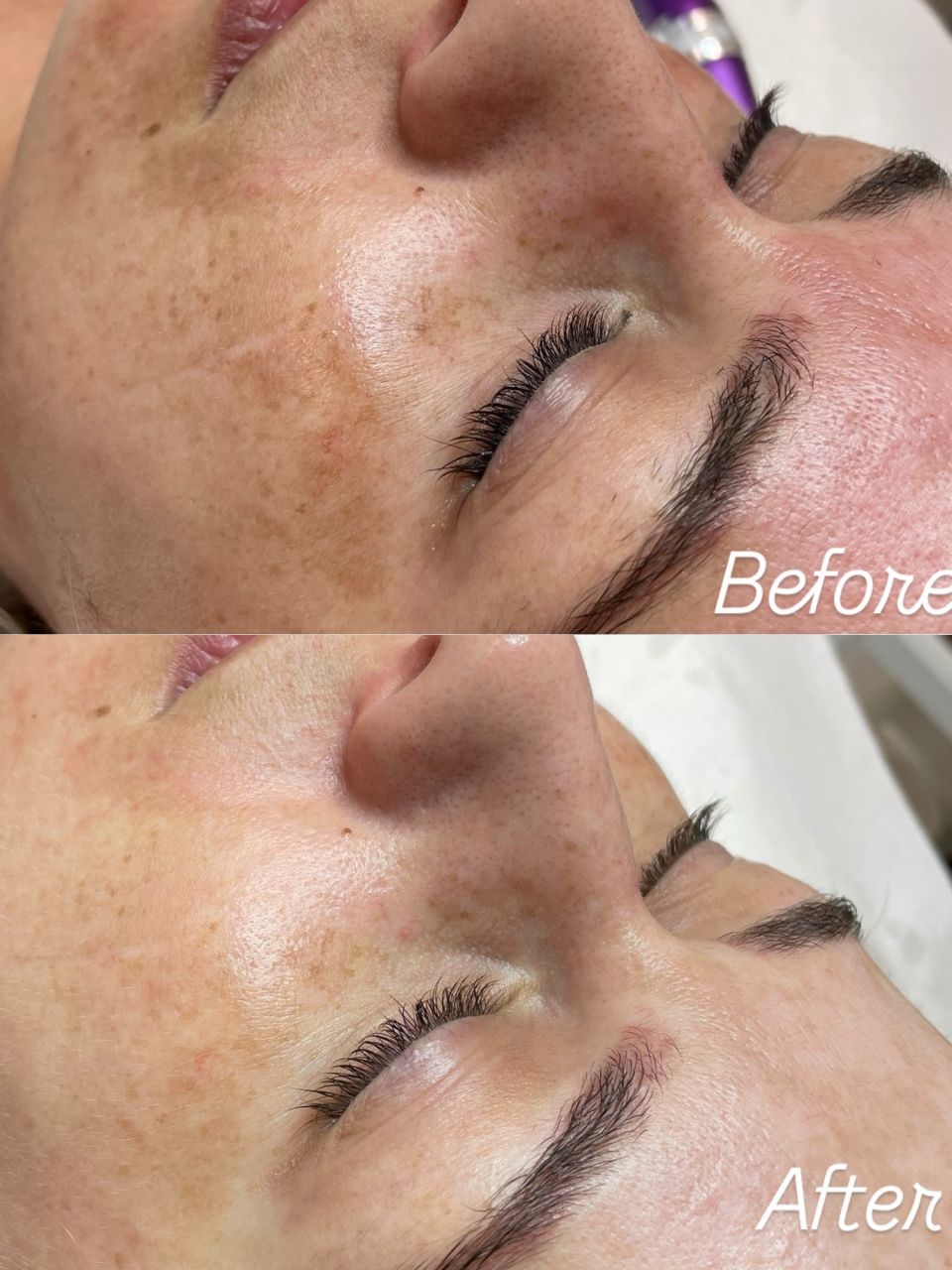 Microneedling made by Corina Dinu - from Stailer