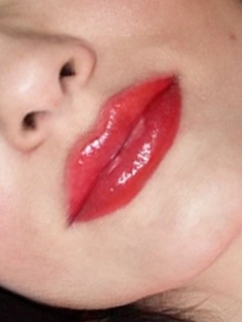 Marire buze cu acid hialuronic