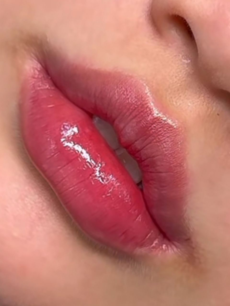 Marire buze cu acid hialuronic made by Ioana Tuș - from Stailer