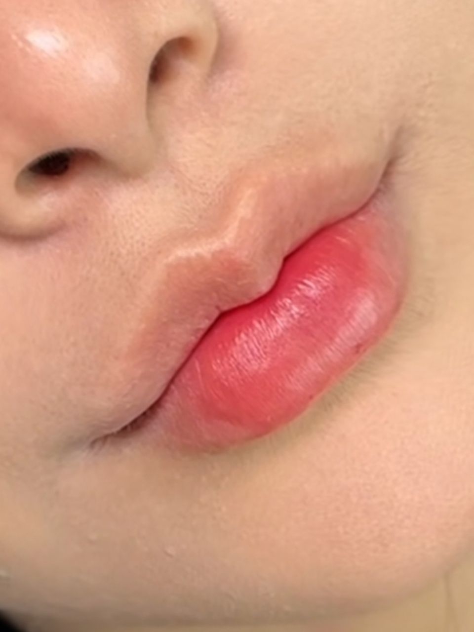 Marire buze cu acid hialuronic made by Ioana Tuș - from Stailer